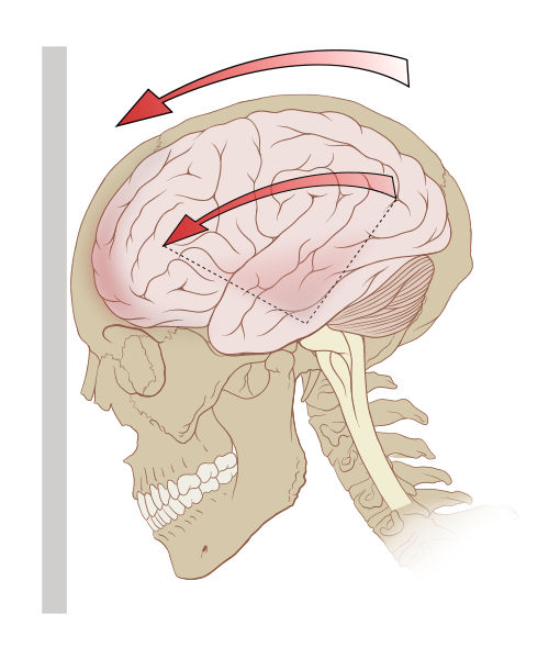 Concussion Awareness 101