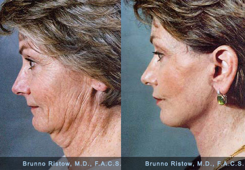 Does this facelift make me look more successful?